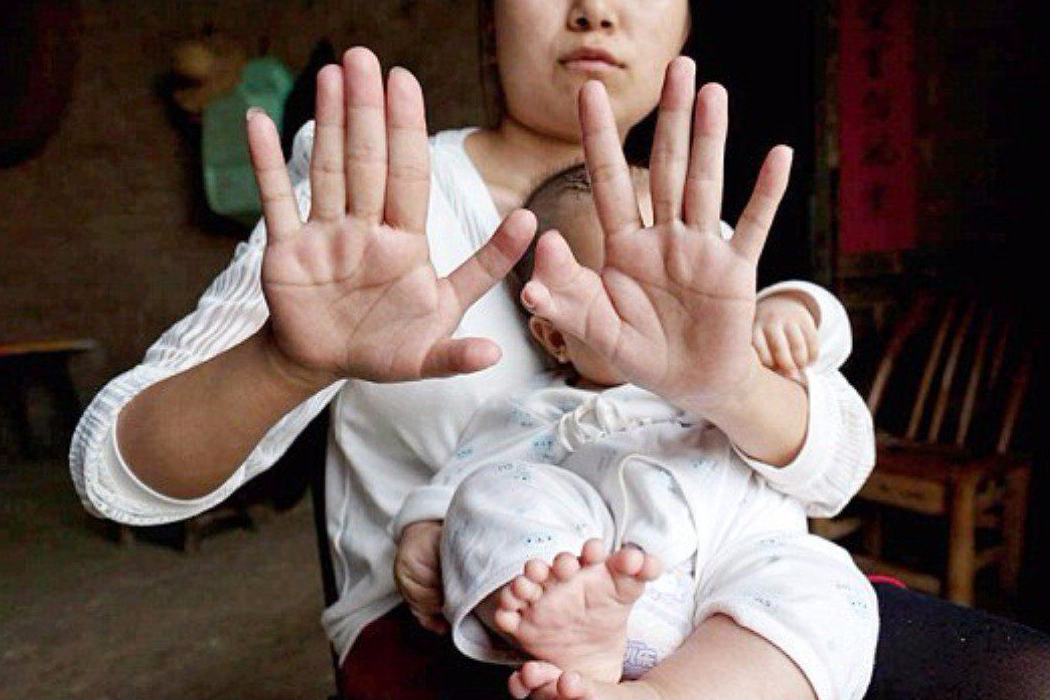 У ребенка большой палец руки больше другого