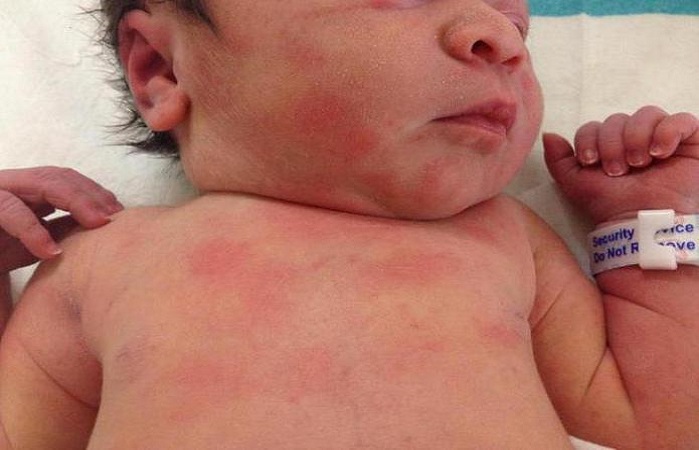 Токсическая сыпь у новорожденных