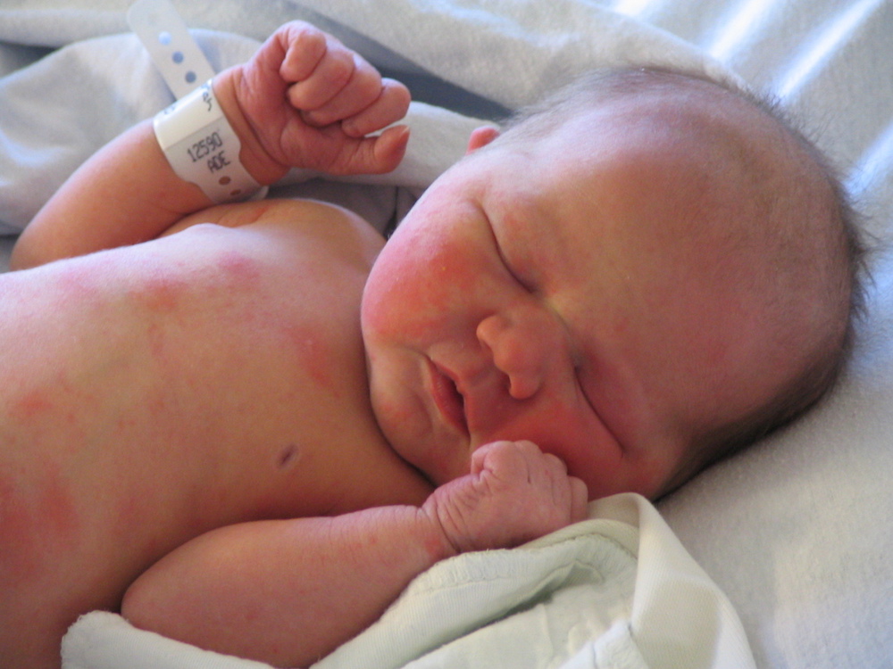 Уход за кожей новорожденного при неонатальной эритеме