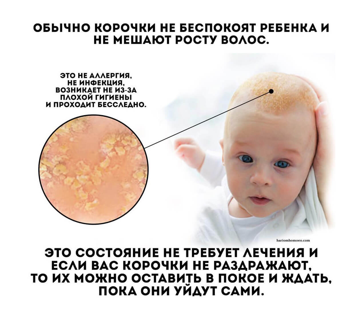 Молочные корочки на голове ребенка: что с ними делать?